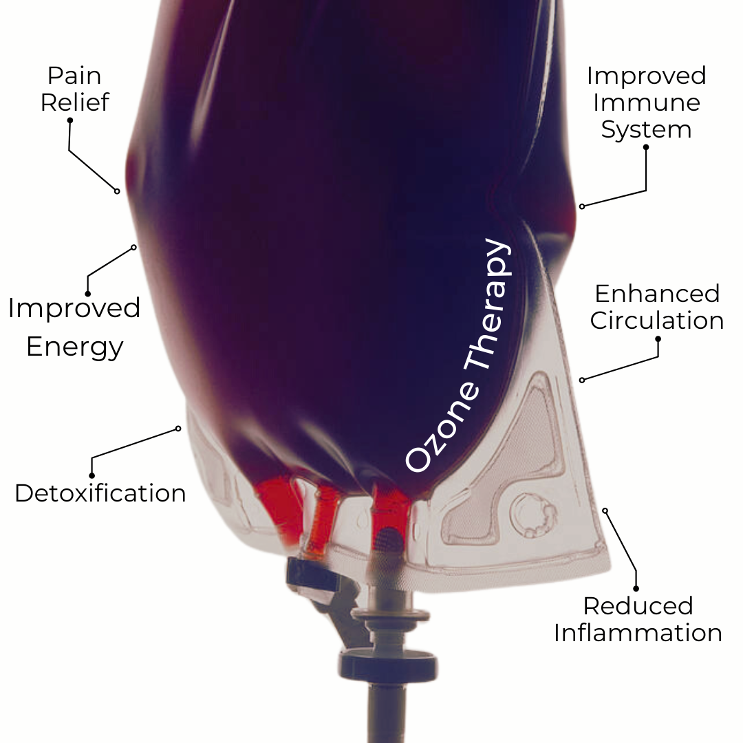 Ozone IV Therapy Ozone IV Therapy